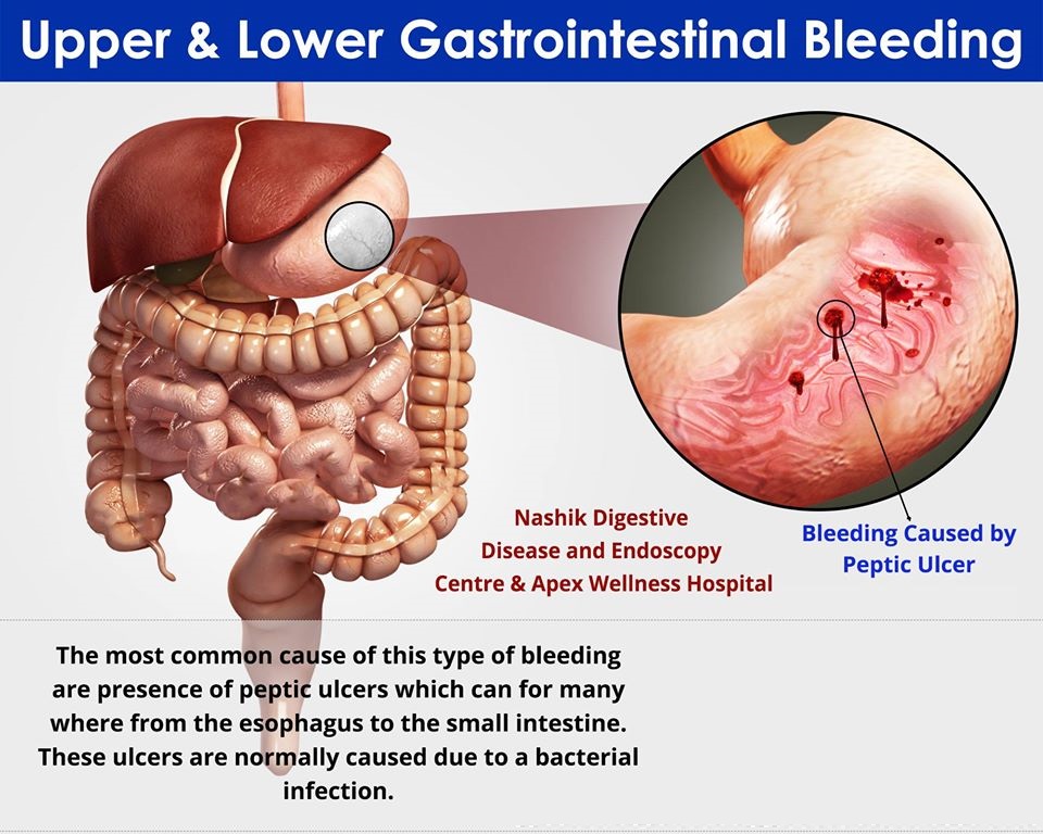 Acidity & GI tretament | Gastroenterologist In Nashik |Dr. Nitin Borse