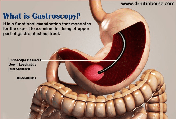 Acidity & GI tretament | Gastroenterologist In Nashik |Dr. Nitin Borse